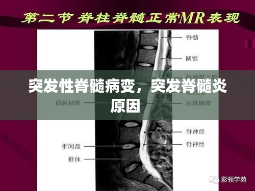 突發(fā)性脊髓病變，突發(fā)脊髓炎原因 